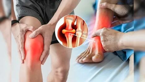 Hautberäicher gëeegent fir Icexin Gel opzebréngen (Knéien, Ellbogen, ënneschte Réck)