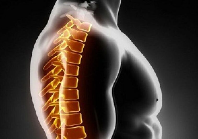 Thoracic Osteochondrose begleet Péng an Unerkennung an der Mëtt vum Réck