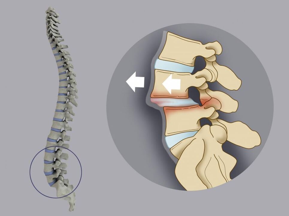 vertebral Mëssverstäerkung als Ursaach vun nidderegen Réckschmerzen