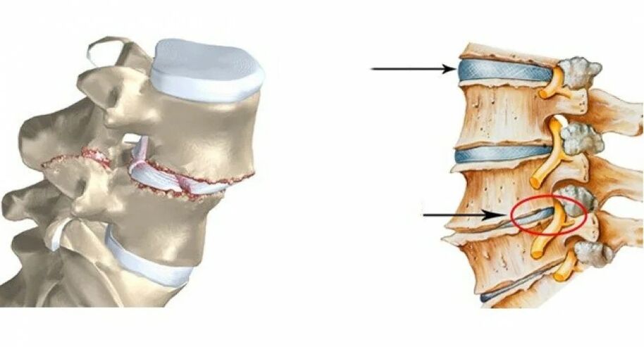 normal a beschiedegt Spinal Disc