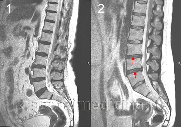 spinal Osteochondrose